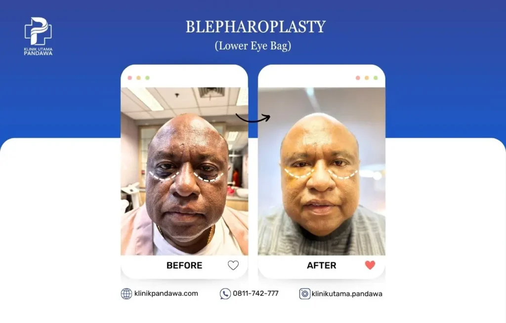 Before After Bedah Estetika - Blepharpplasty