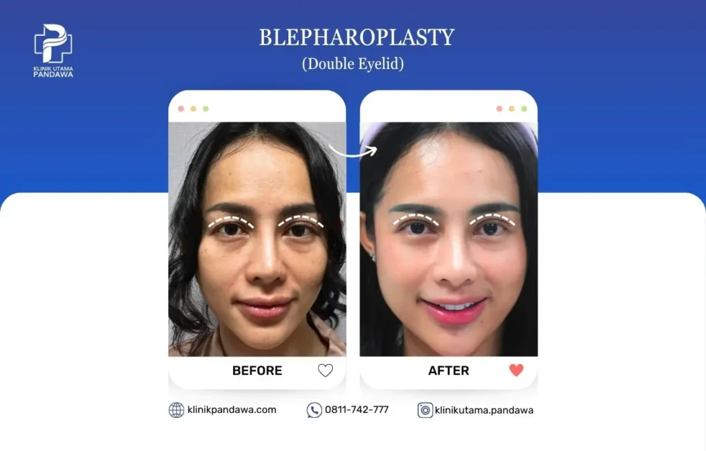 Before After Bedah Estetika - Double Eyelid