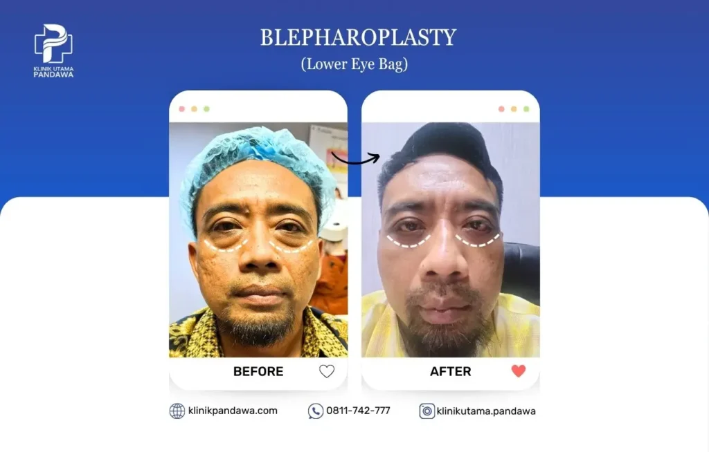 Before After Bedah Estetika - Lower Eye Bag