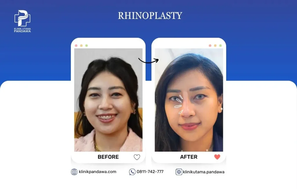 Before After Bedah Estetika - Operasi Hidung