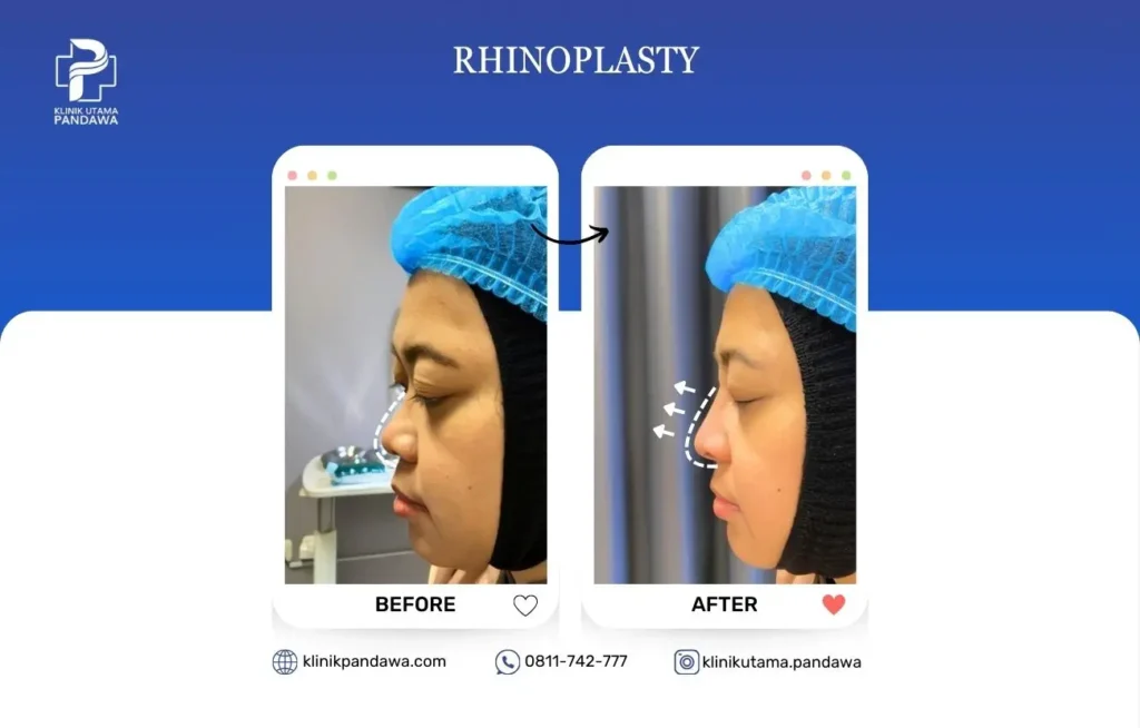 Before After Bedah Estetika - Rhinoplasty