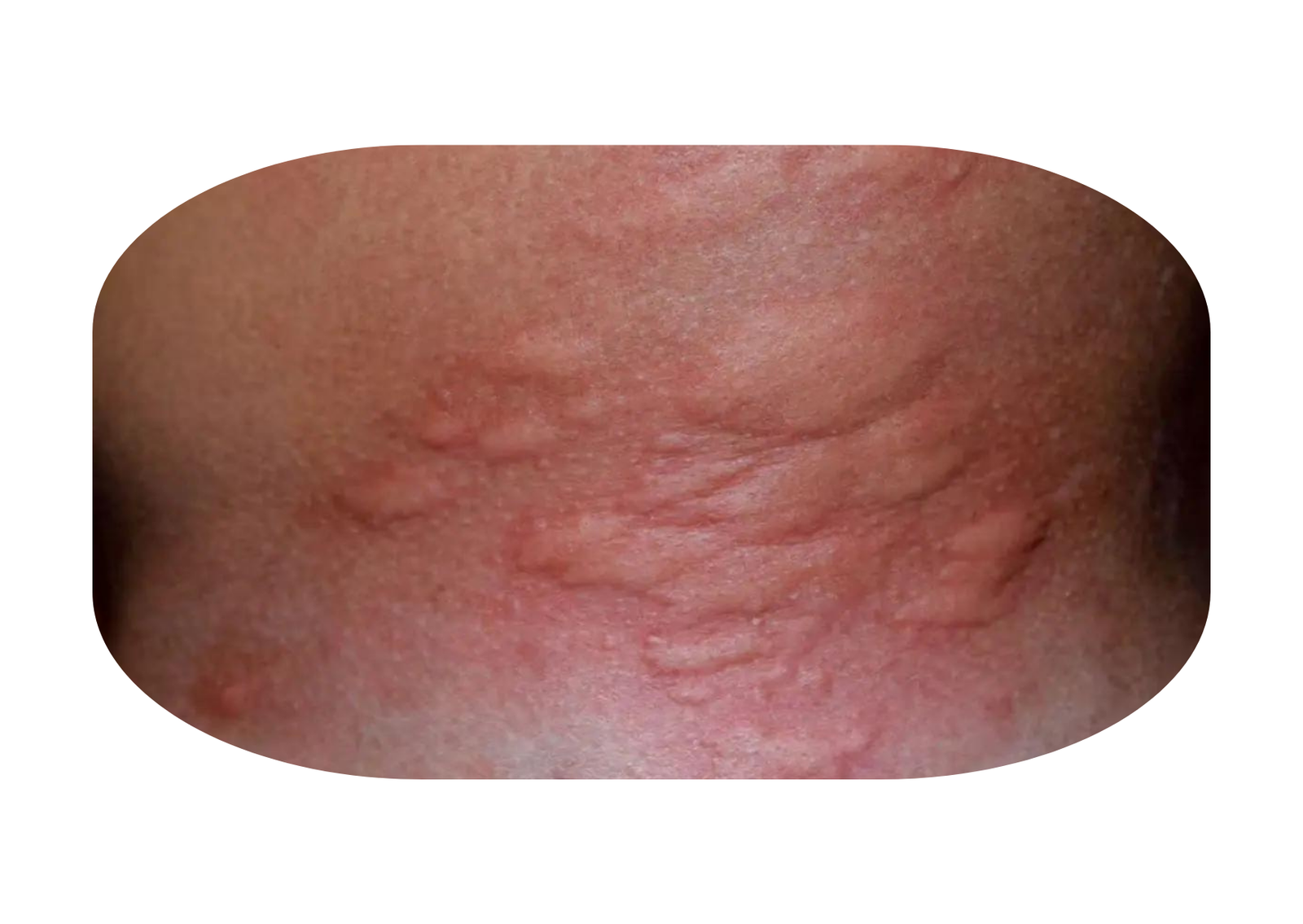 Gejala Dermatitis 1