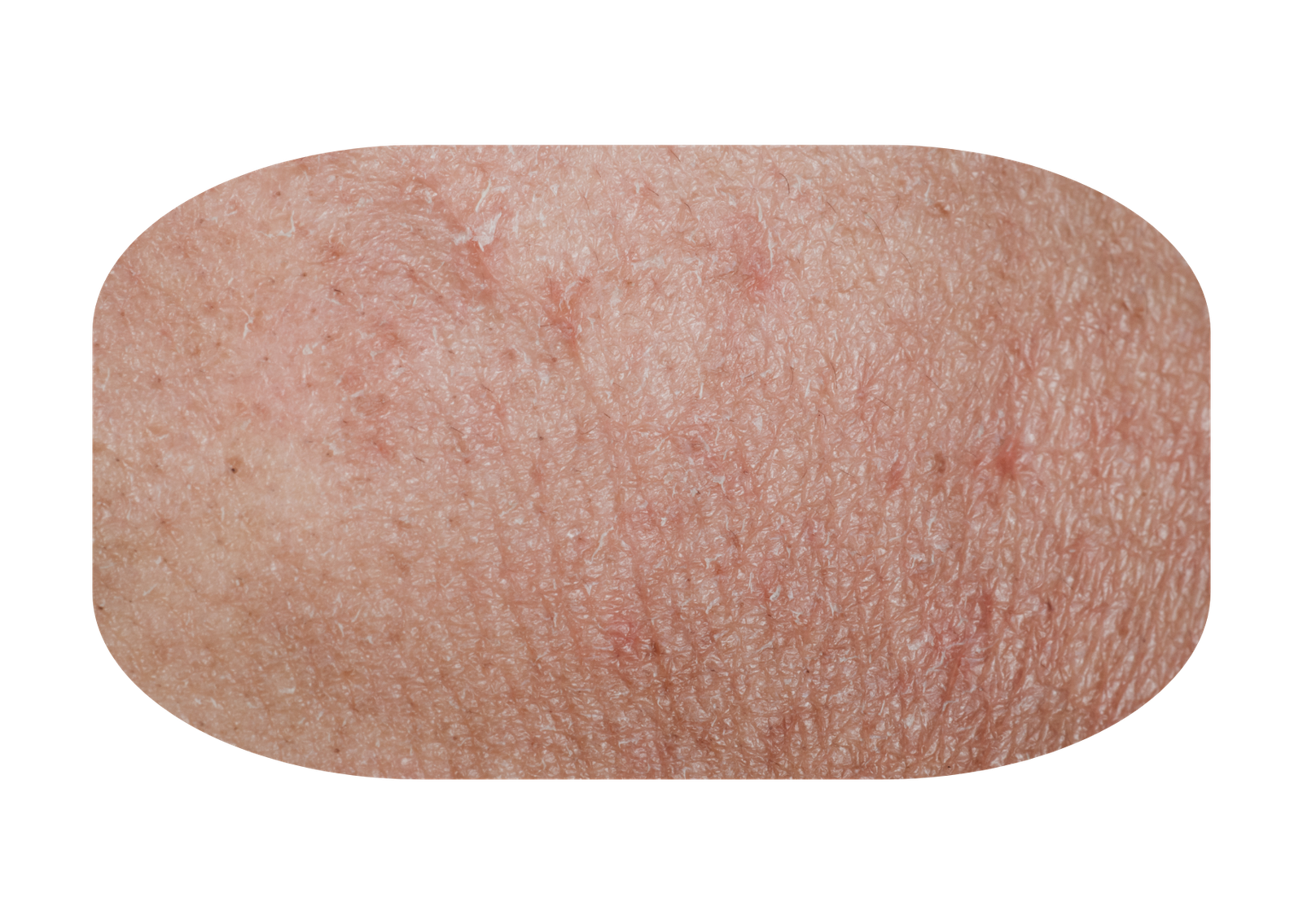 Gejala Psoriasis 1