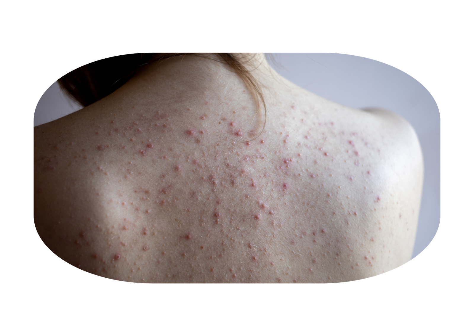 Jenis Psoriasis 4