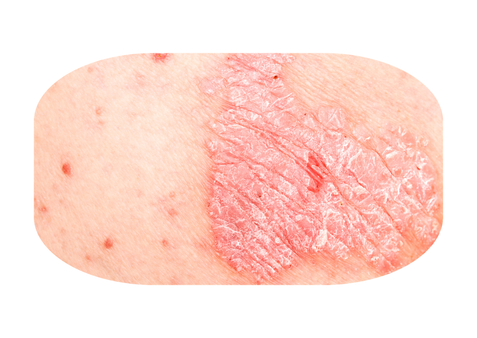 Jenis Psoriasis 7