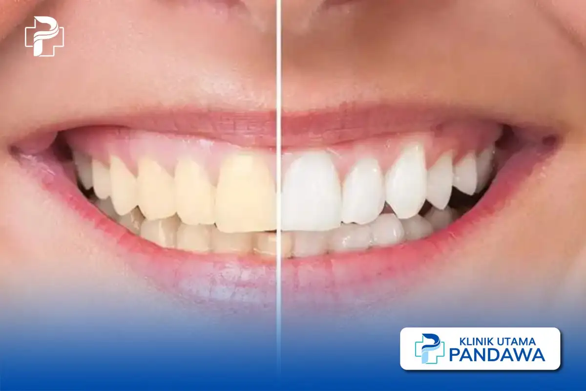 perbedaan veneer dan bleaching gigi