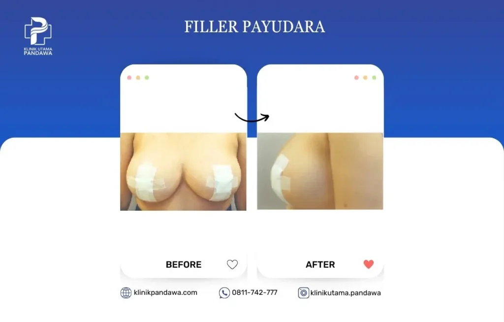 Before After Bedah Filler Payudara