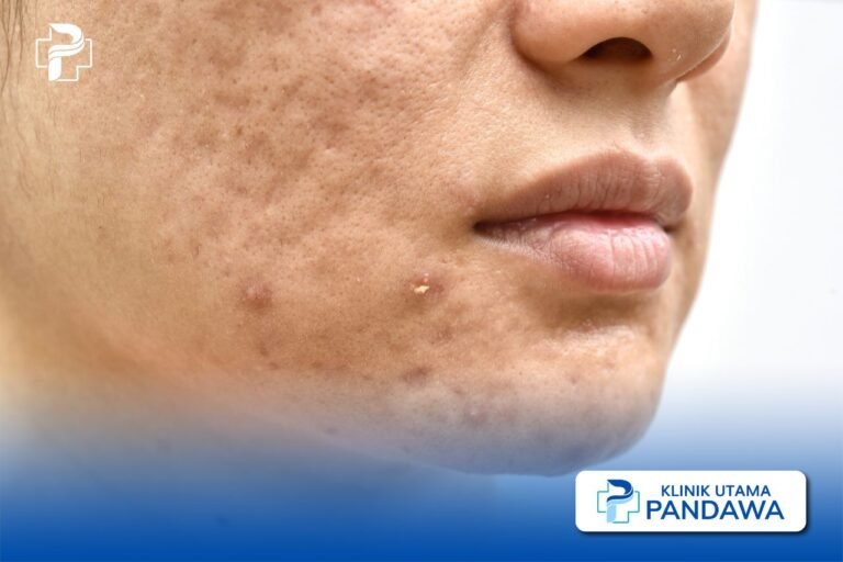 14 Cara Menghilangkan Bopeng Bekas Jerawat (Acne Scars) - Klinik Pandawa