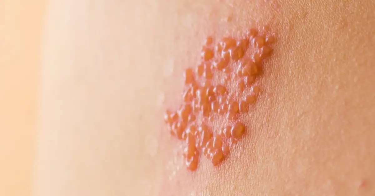 gambar herpes zoster