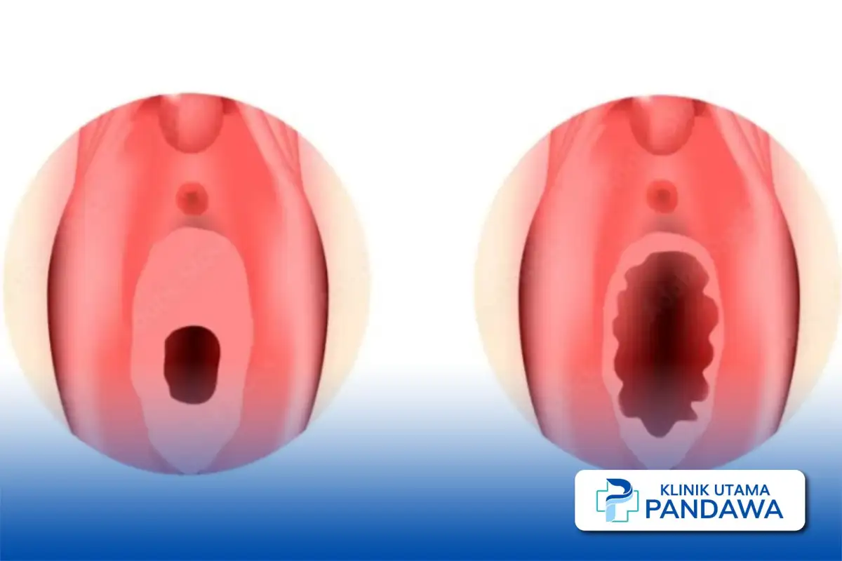 hymenoplasty di Jakarta