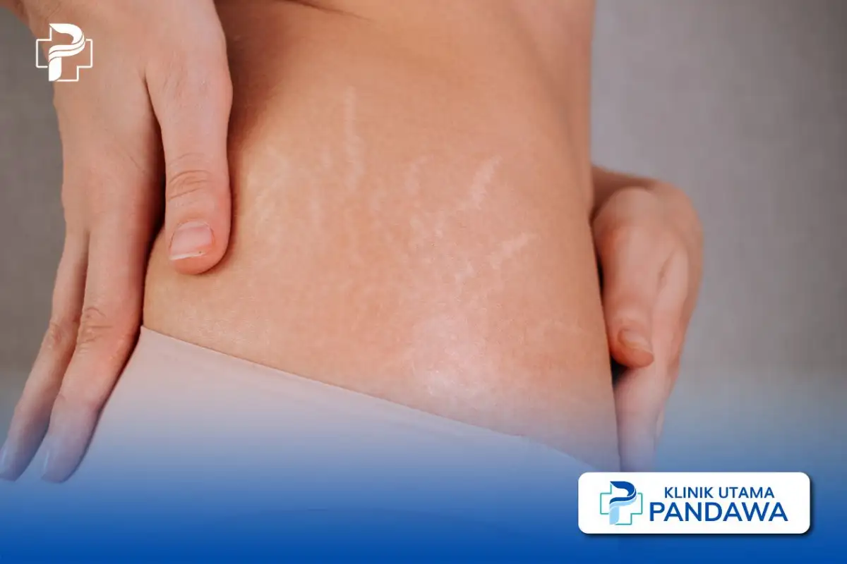 perbedaan selulit dan stretch mark