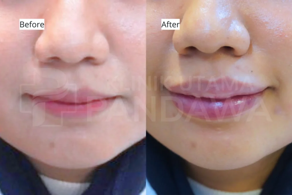Filler Bibir