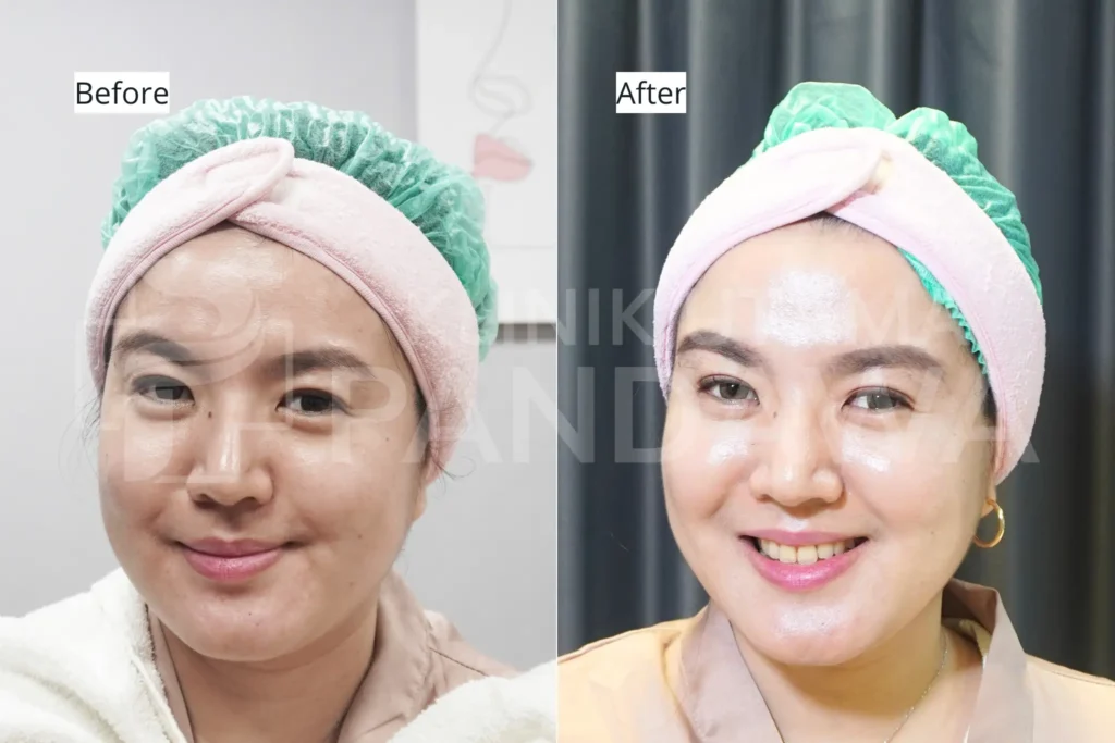 before after profhilo