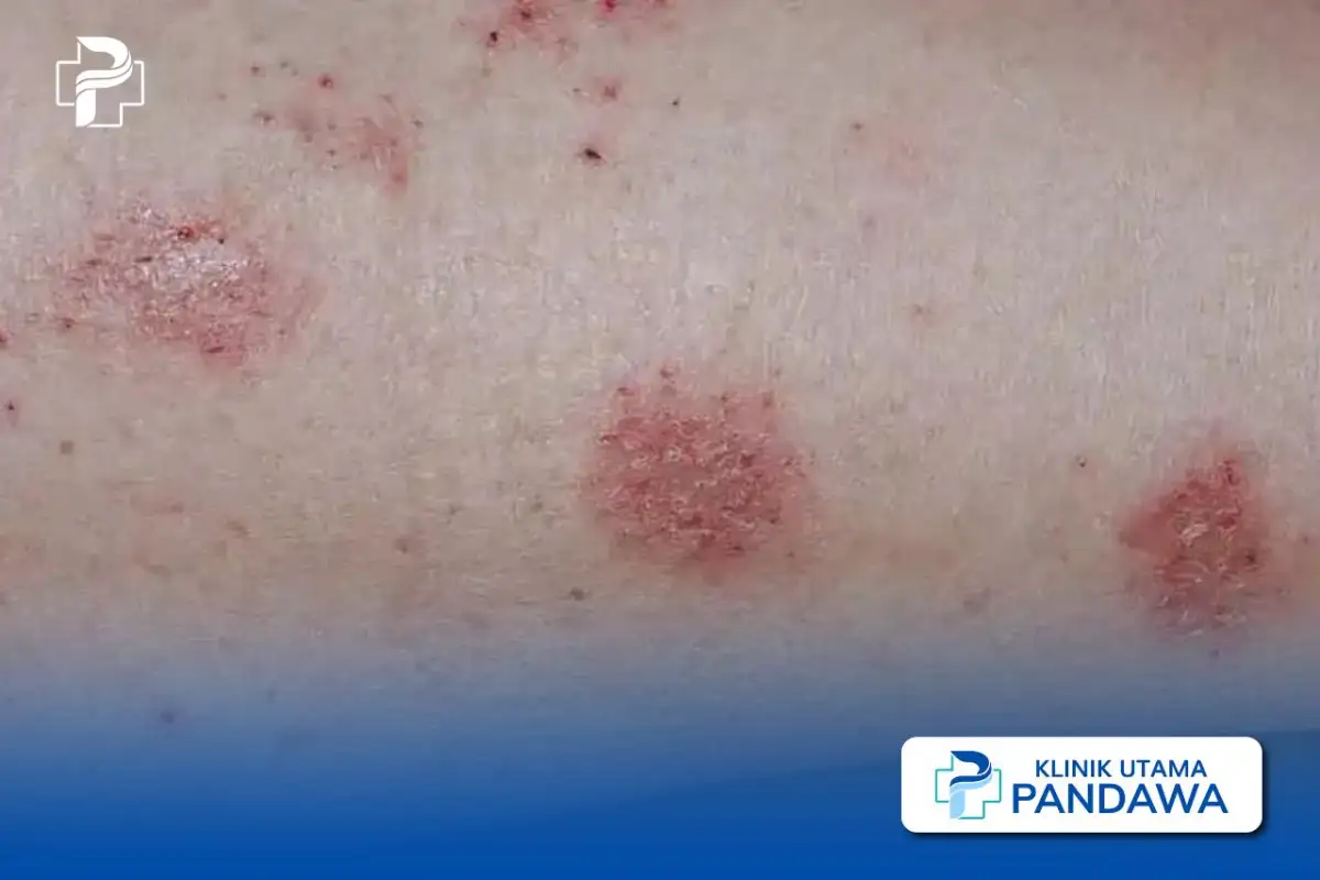 pengobatan dermatitis numularis