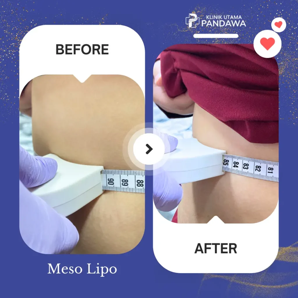 Before After Meso Lipo