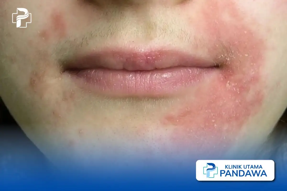 pengobatan dermatitis perioral