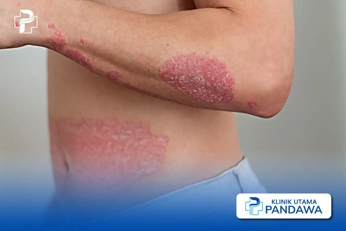 psoriasis