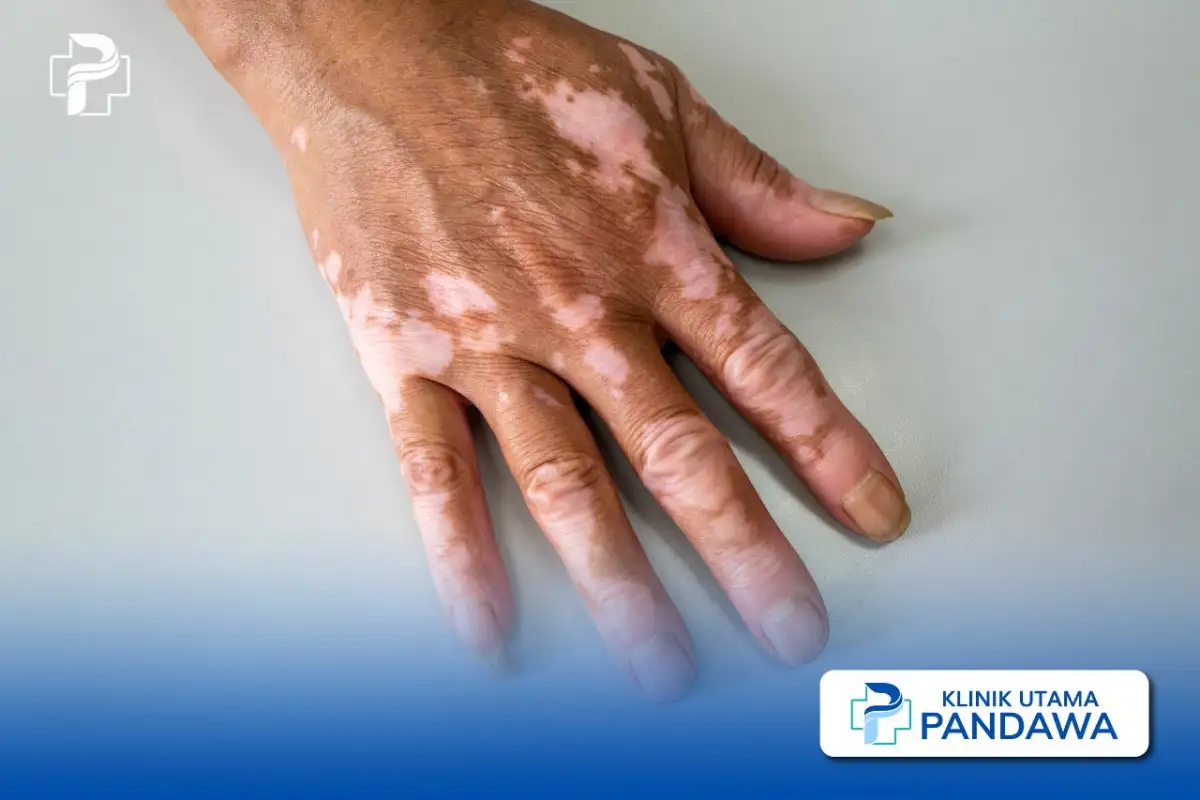 Vitiligo