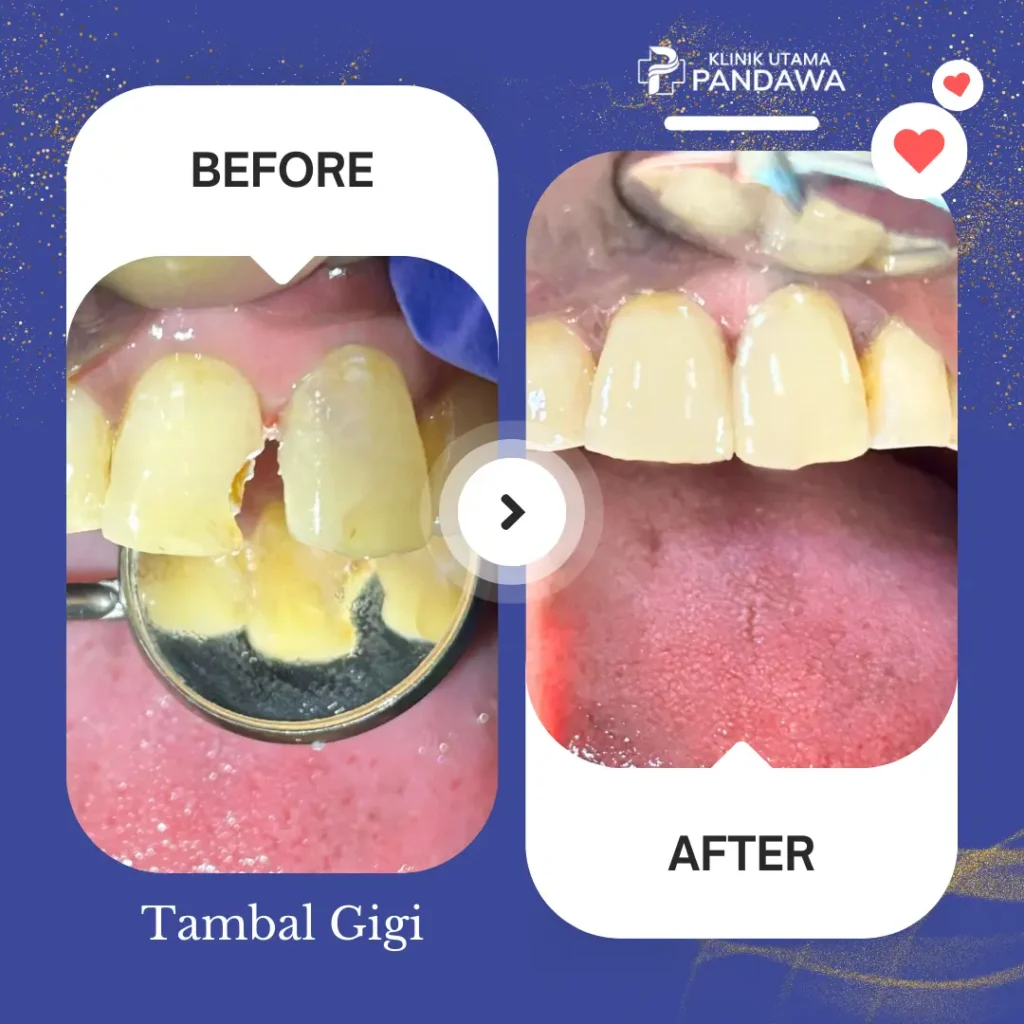 Before After Tambal Gigi