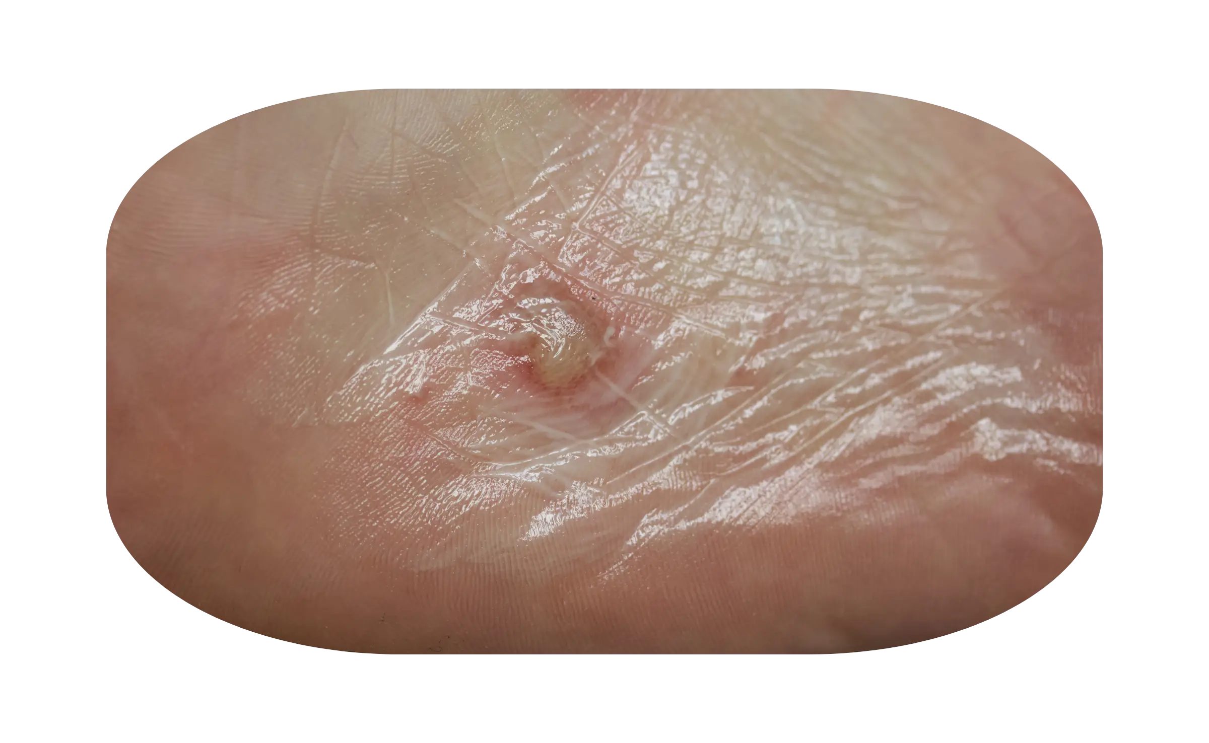 Dermatitis Dishidrotik