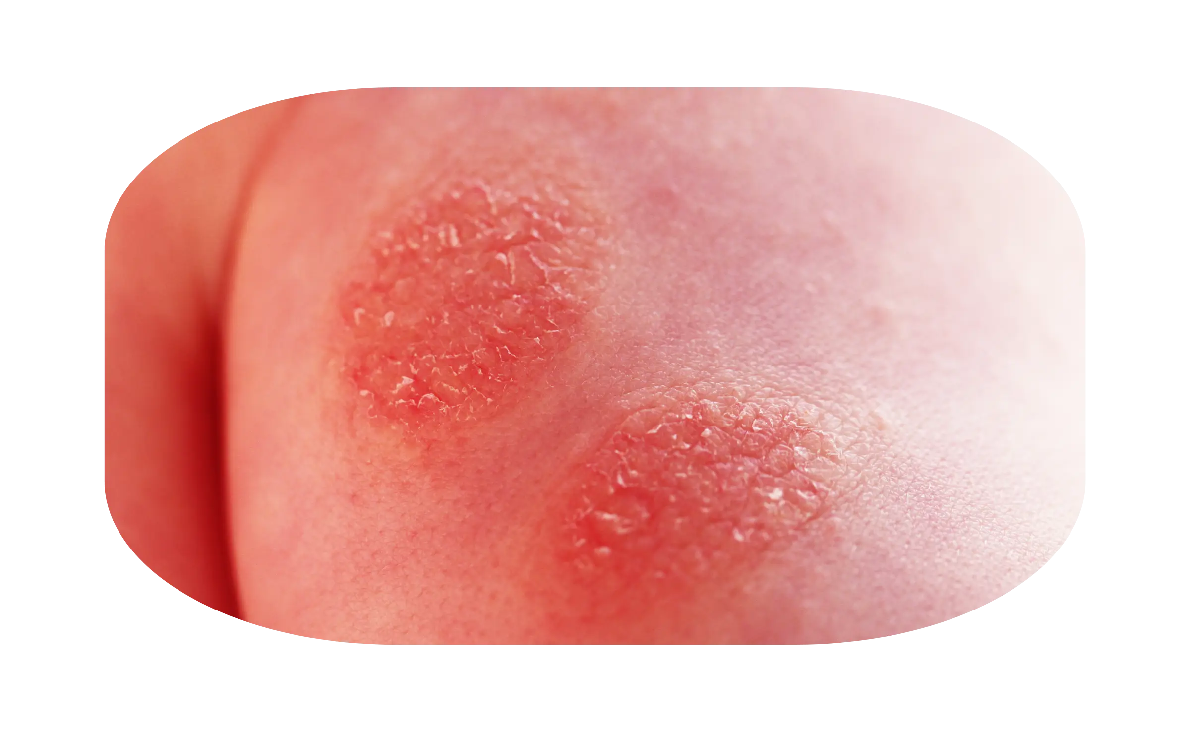 Dermatitis Numularis