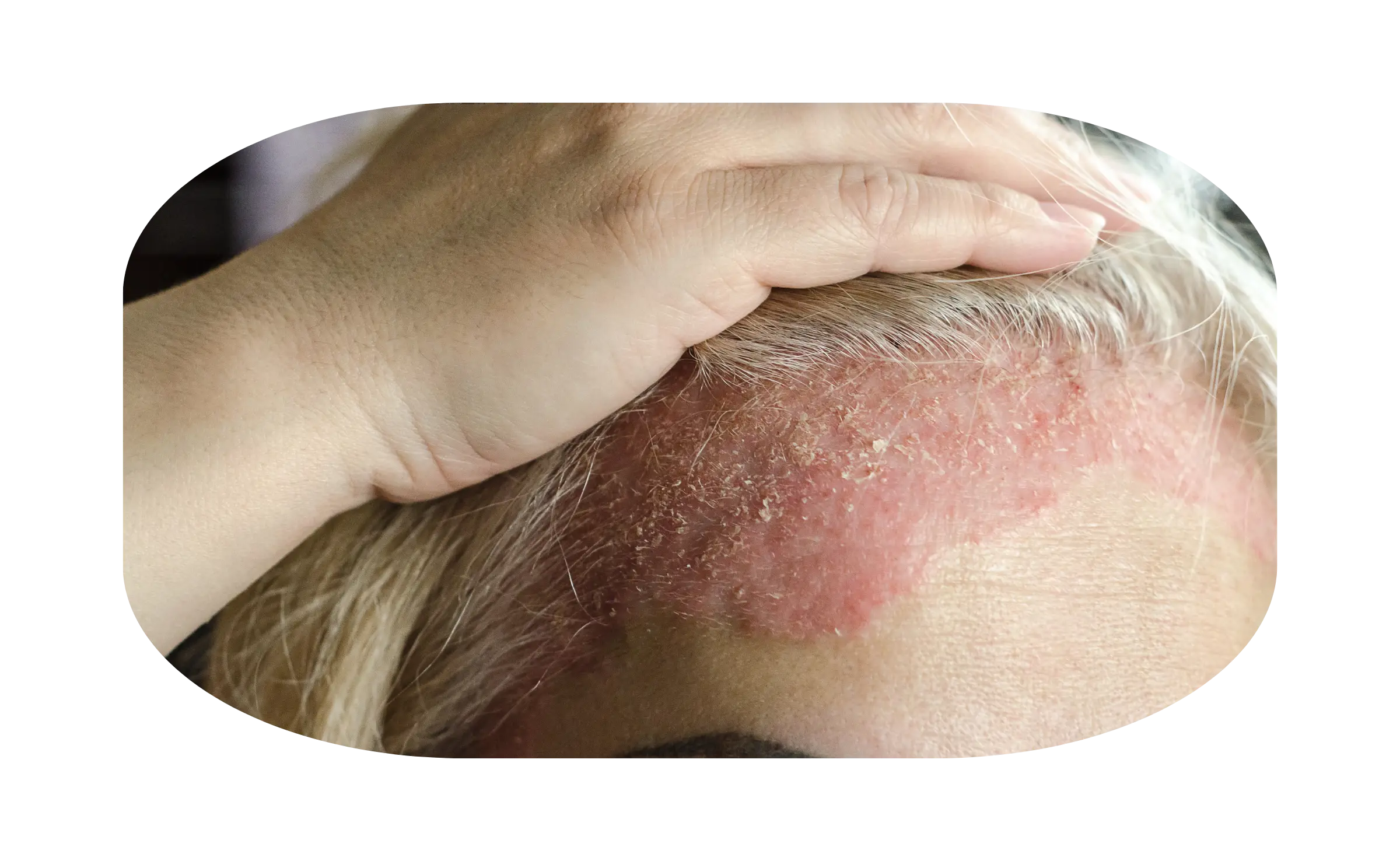 Dermatitis Seboroik