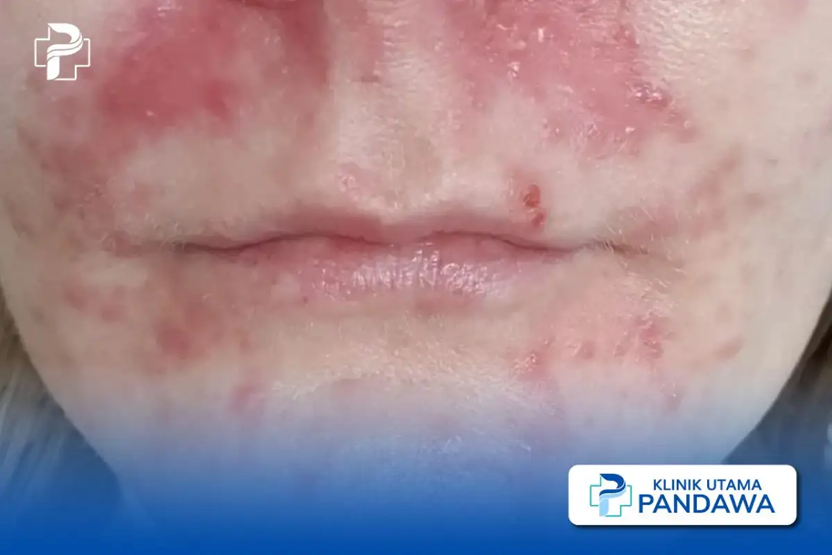 dermatitis perioral