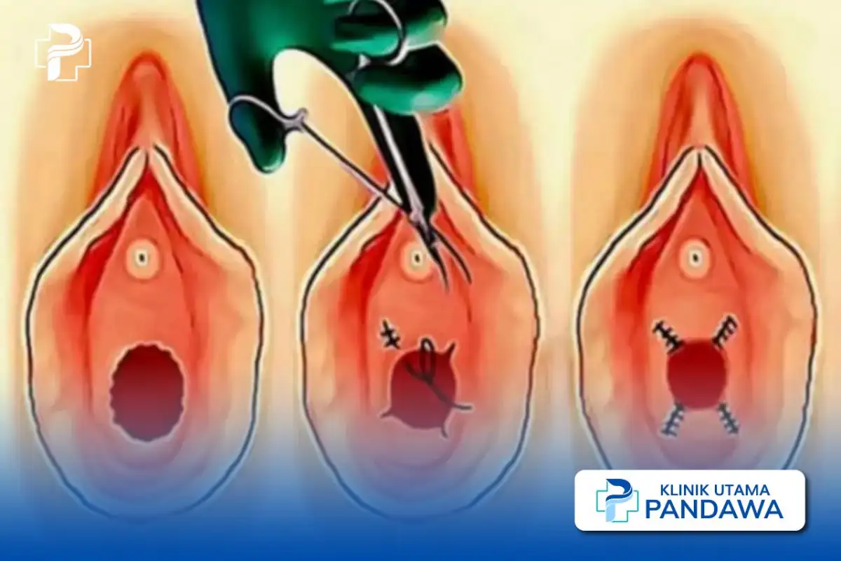 hymenoplasty adalah