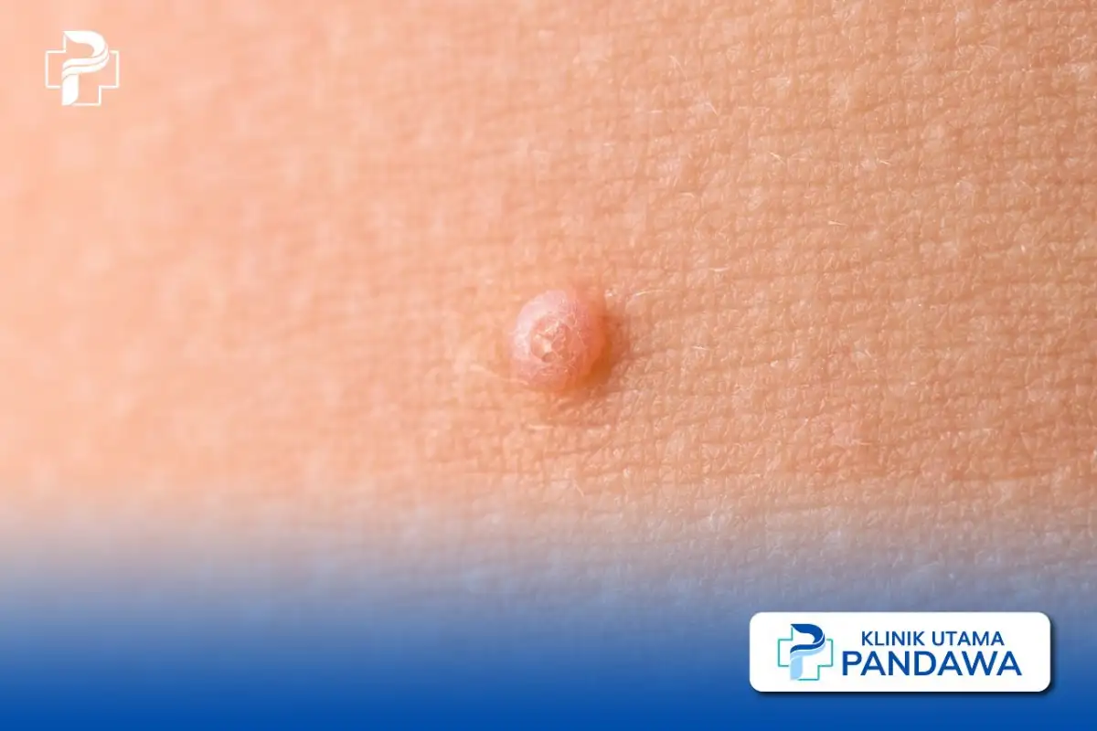 molluscum contagiosum