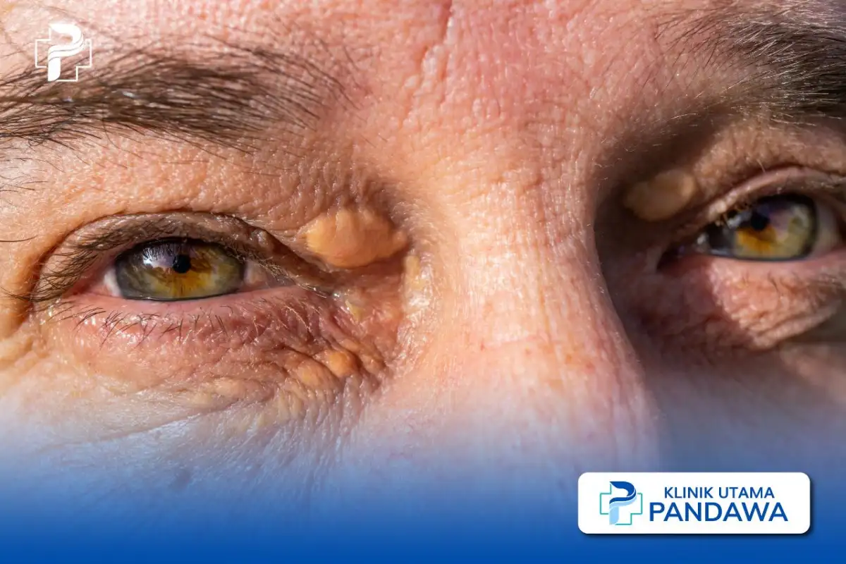 xanthelasma