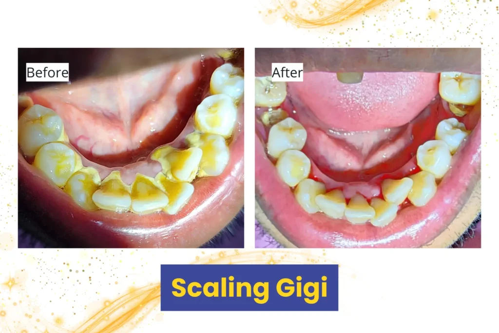 Before After Scaling Gigi 3