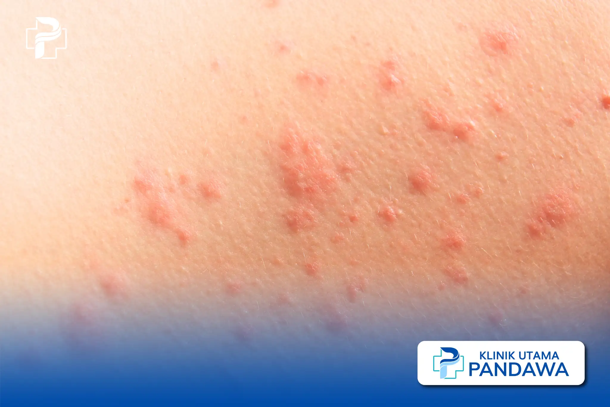 Dermatitis Iritan Kontak