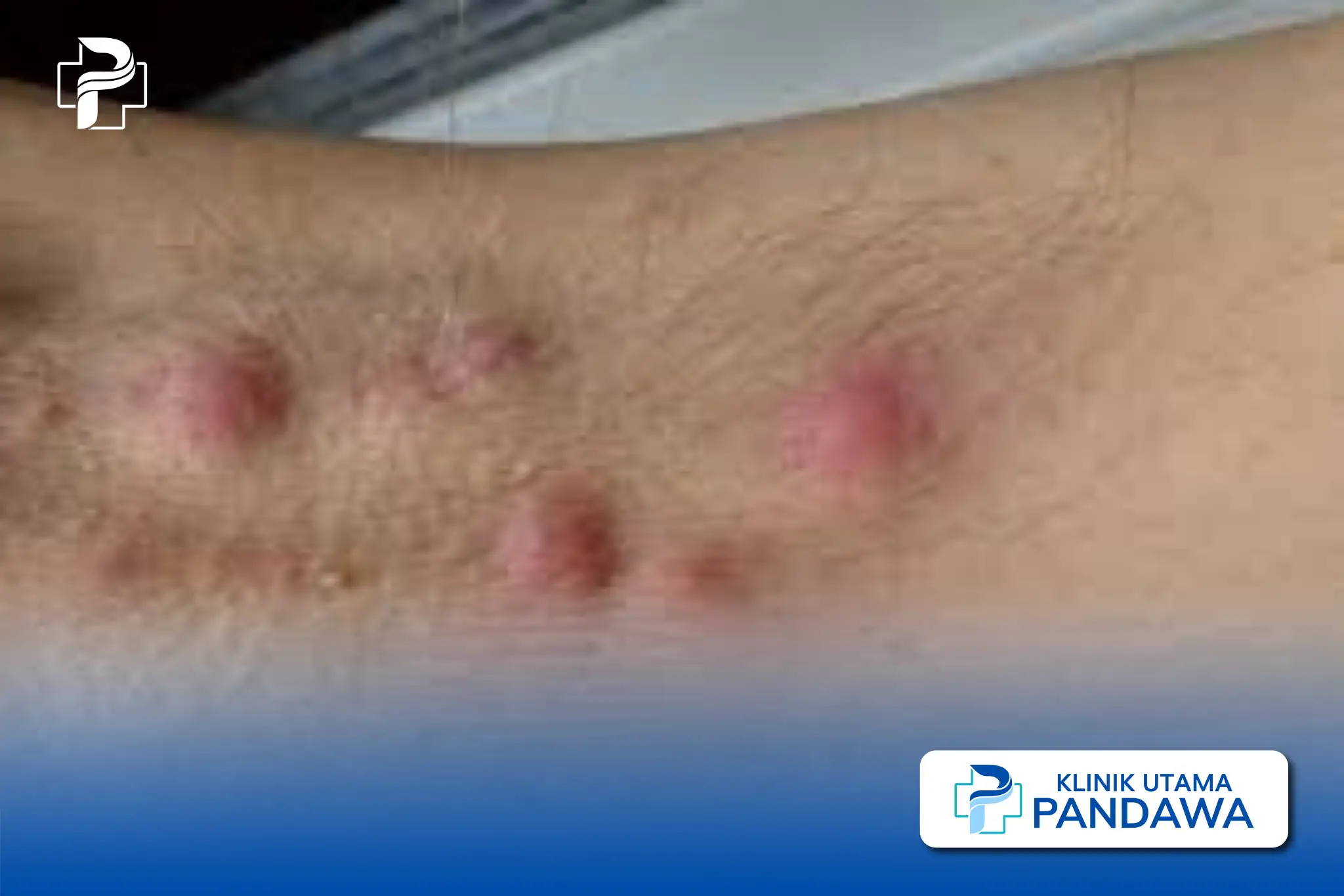 Hidradenitis suppurativa