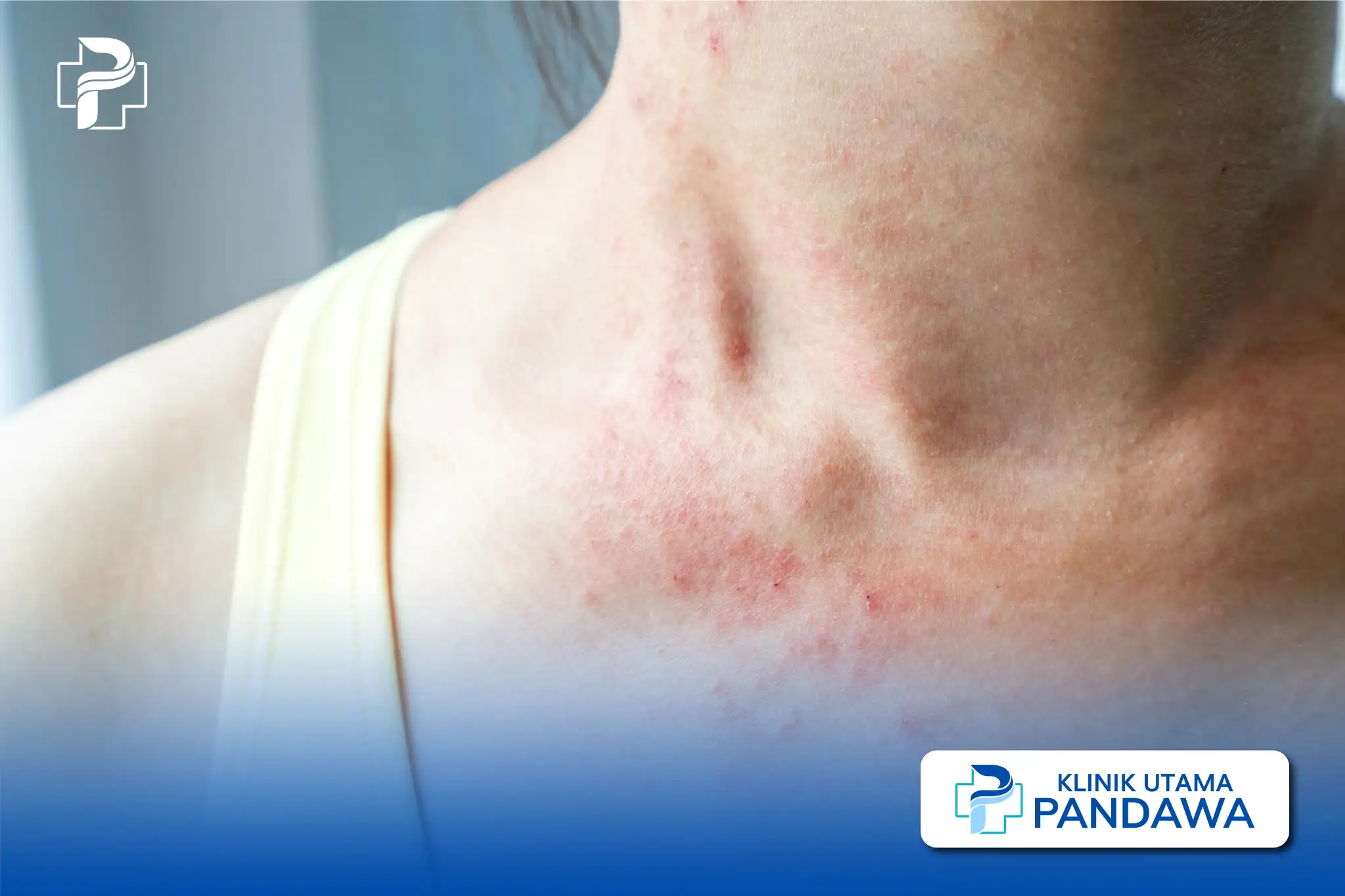 Psoriasis Inversa