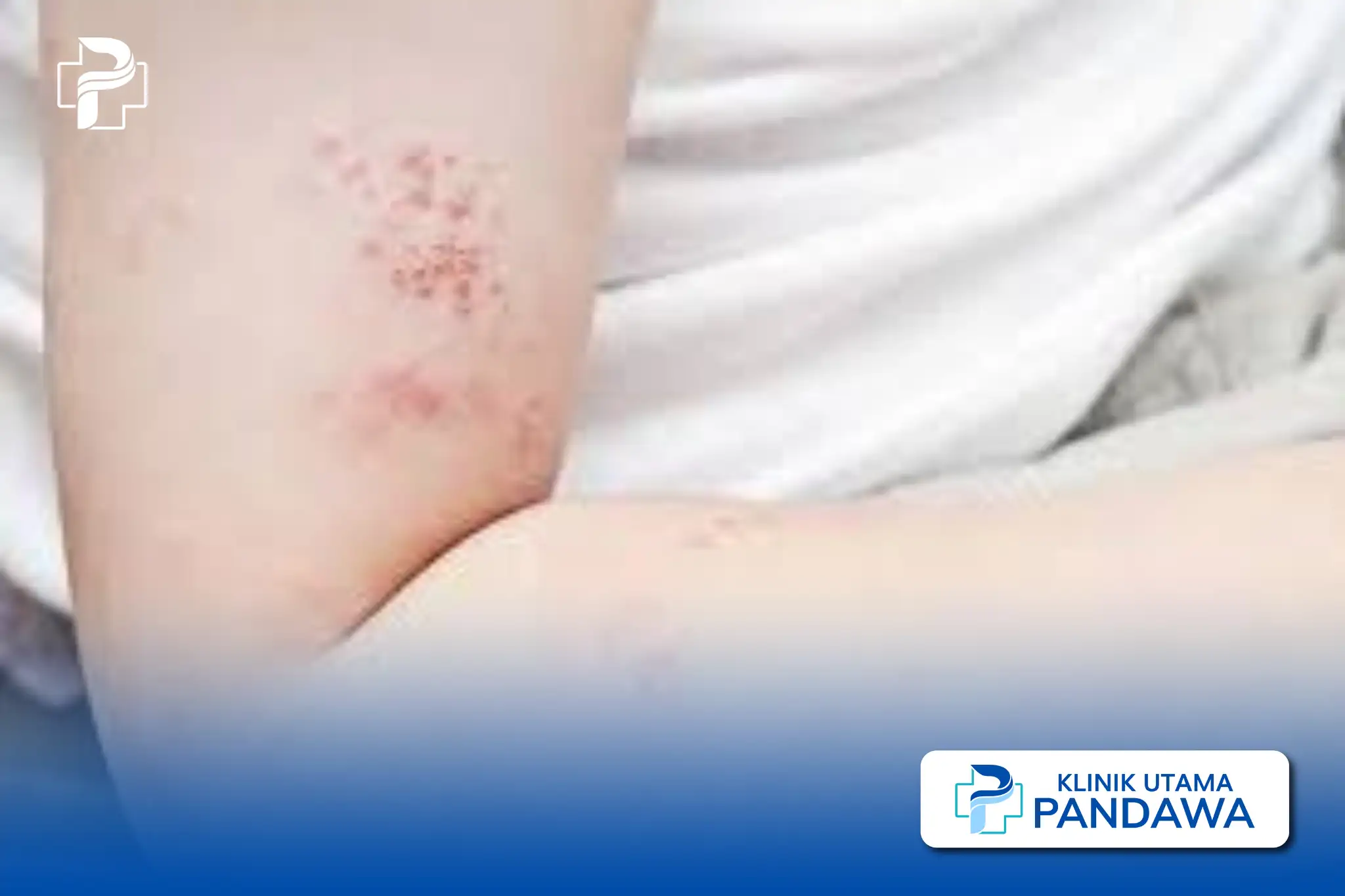 Staphylococcal Scalded Skin Syndrome