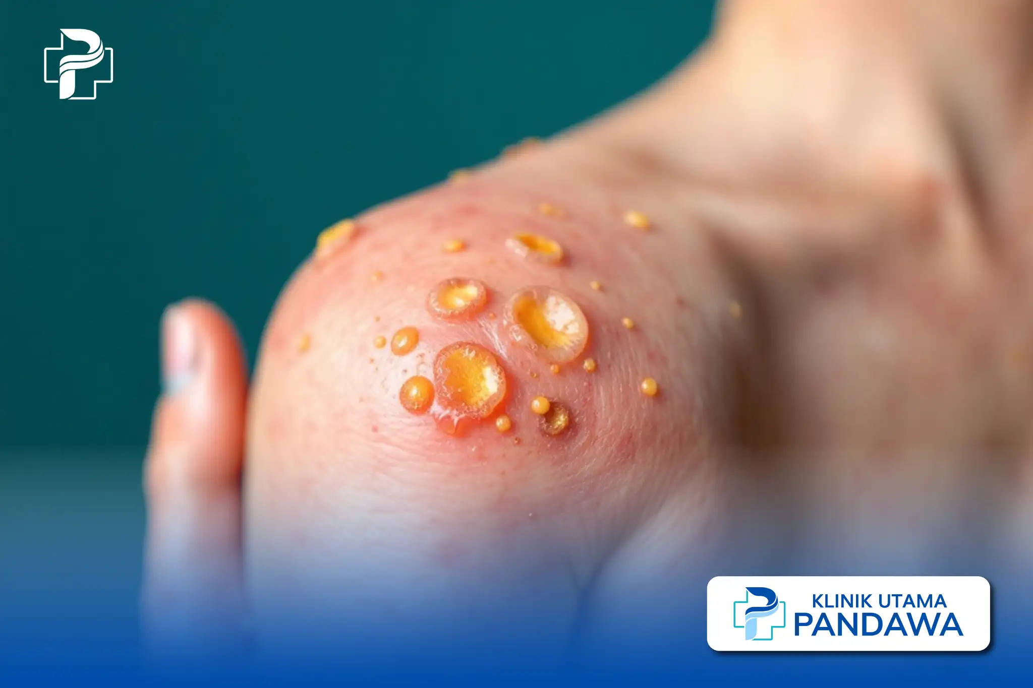 Xanthoma