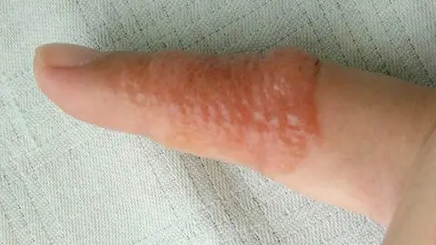 dyshidrotic eczema