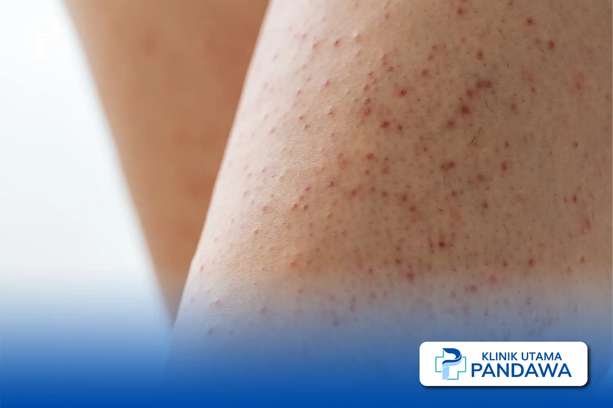 keratosis pilaris