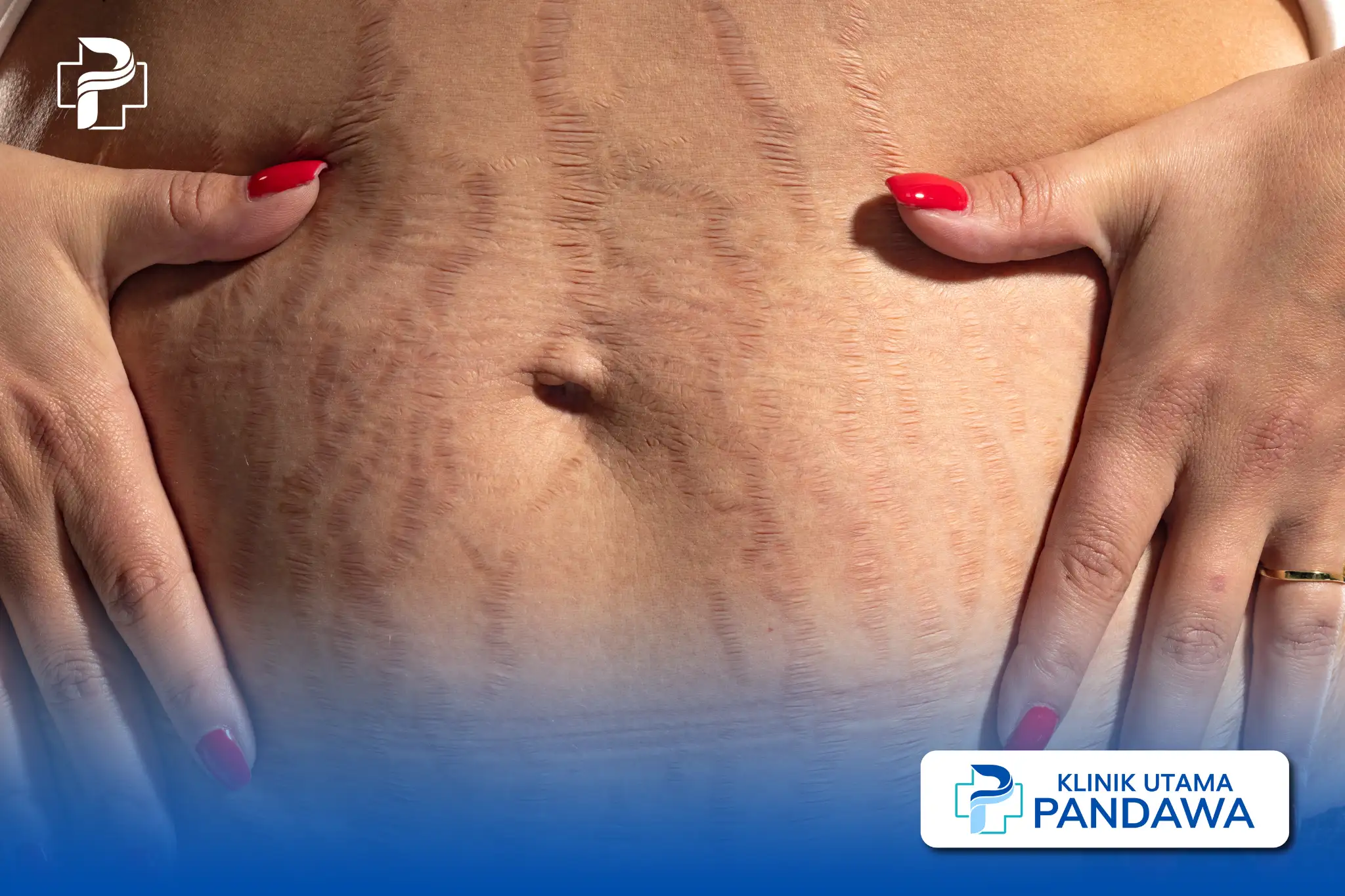 perbedaan stretch mark merah dan putih