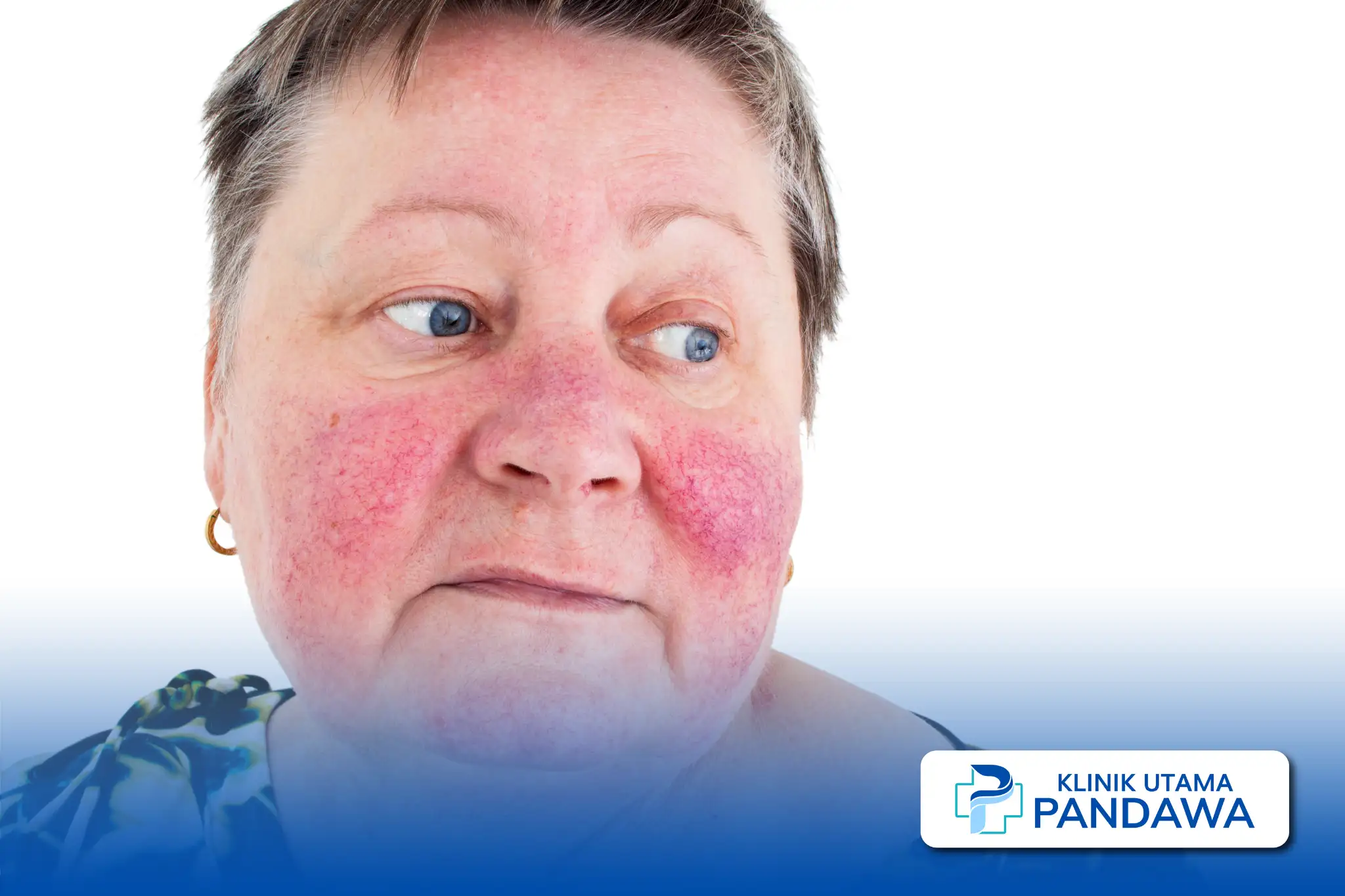 rosacea