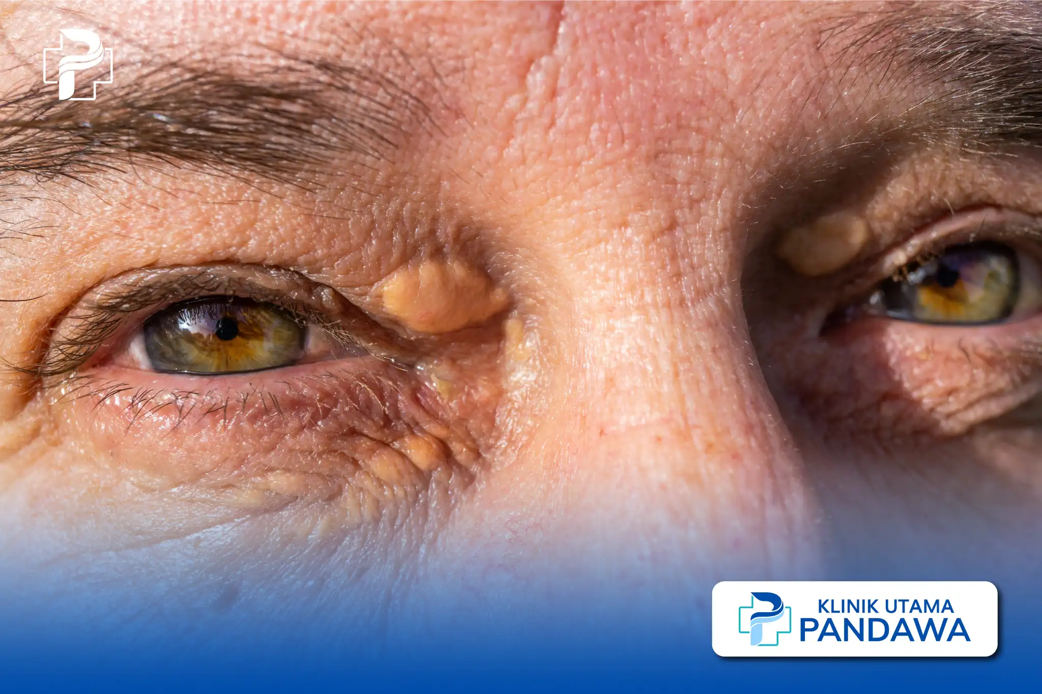 xanthelasma