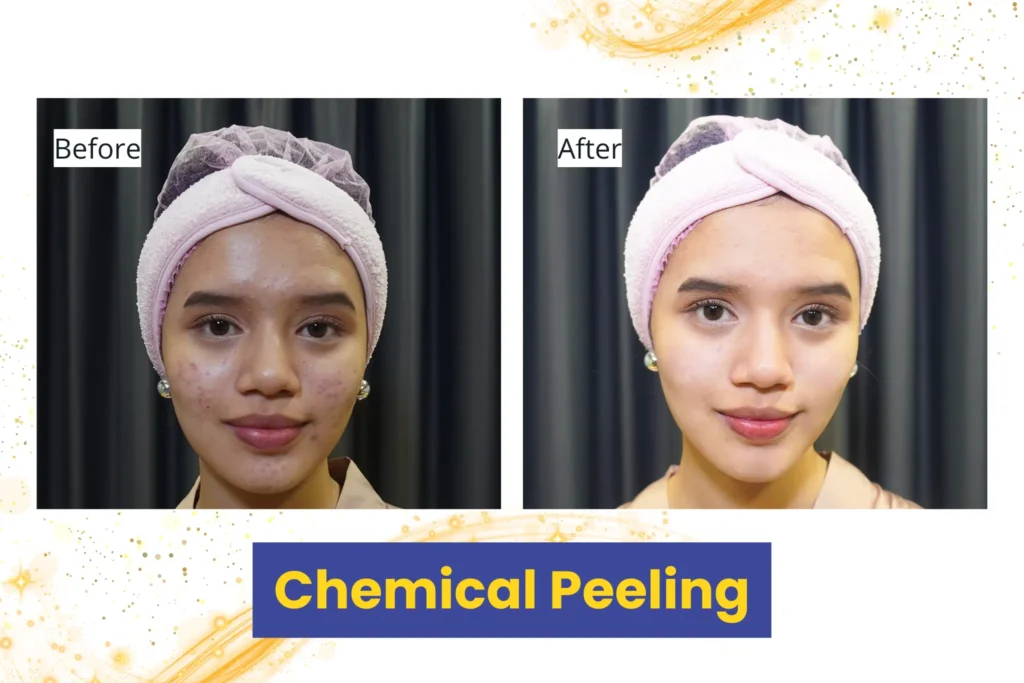 Testimoni - Chemical Peeling