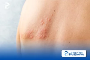 herpes di punggung
