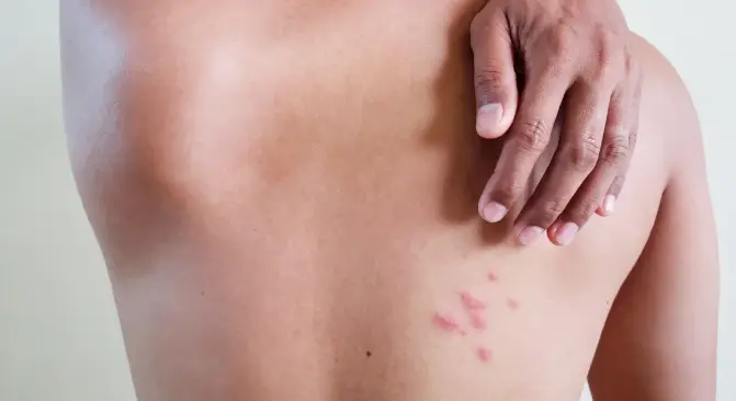 herpes zoster di punggung
