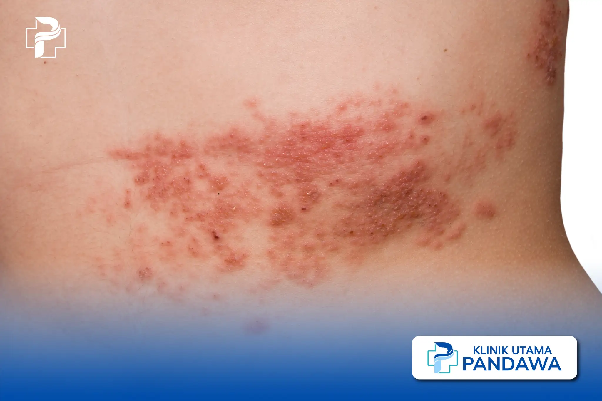 Herpes di leher