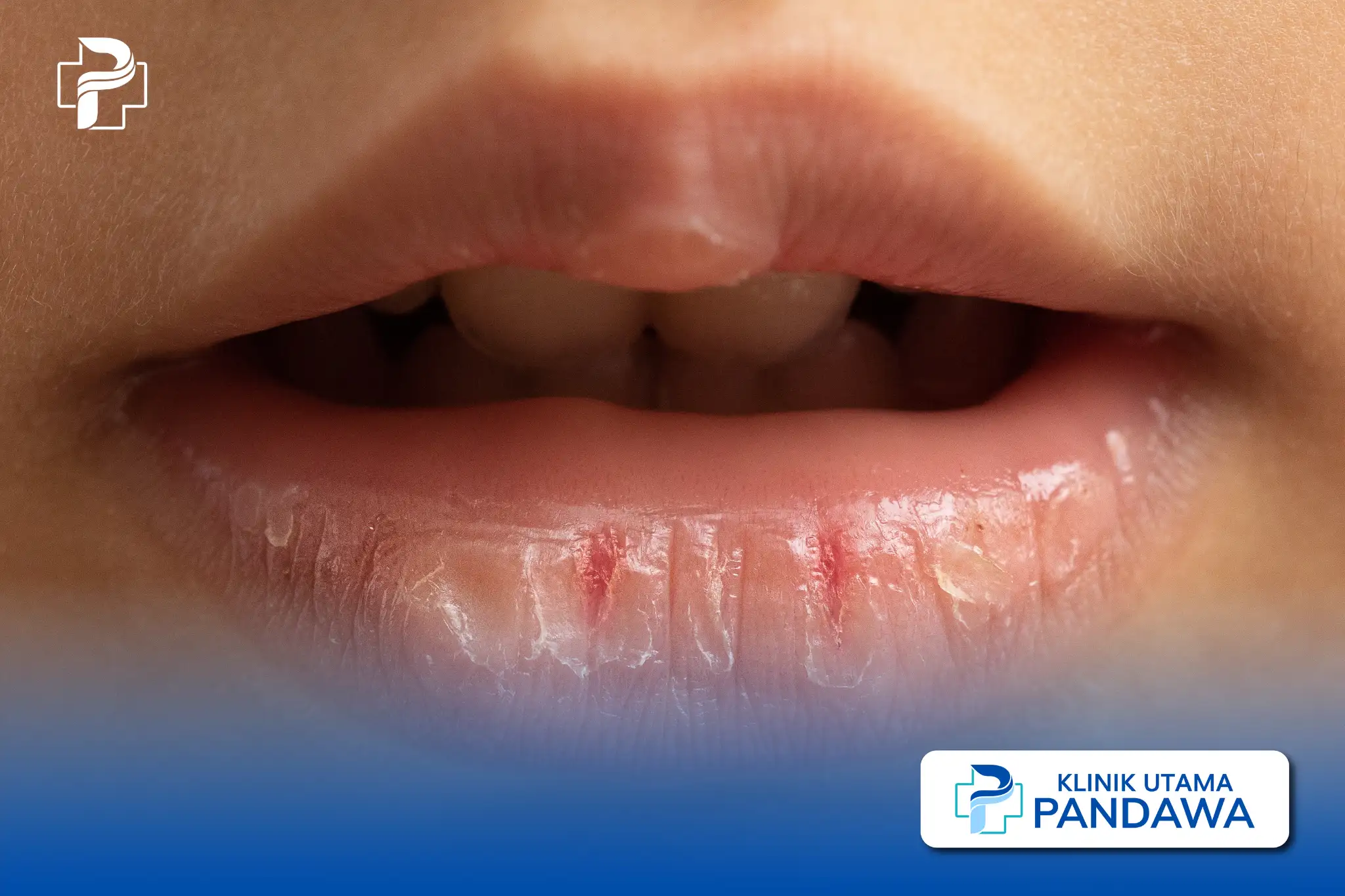 bibir kering pecah pecah