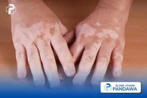 vitiligo pada anak