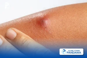 abses kulit