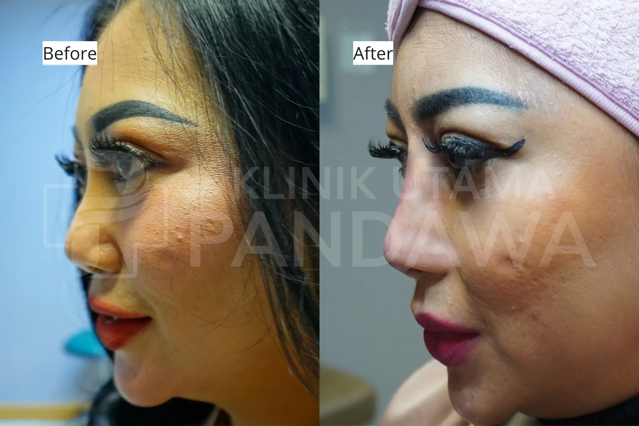 rhinoplasty hidung