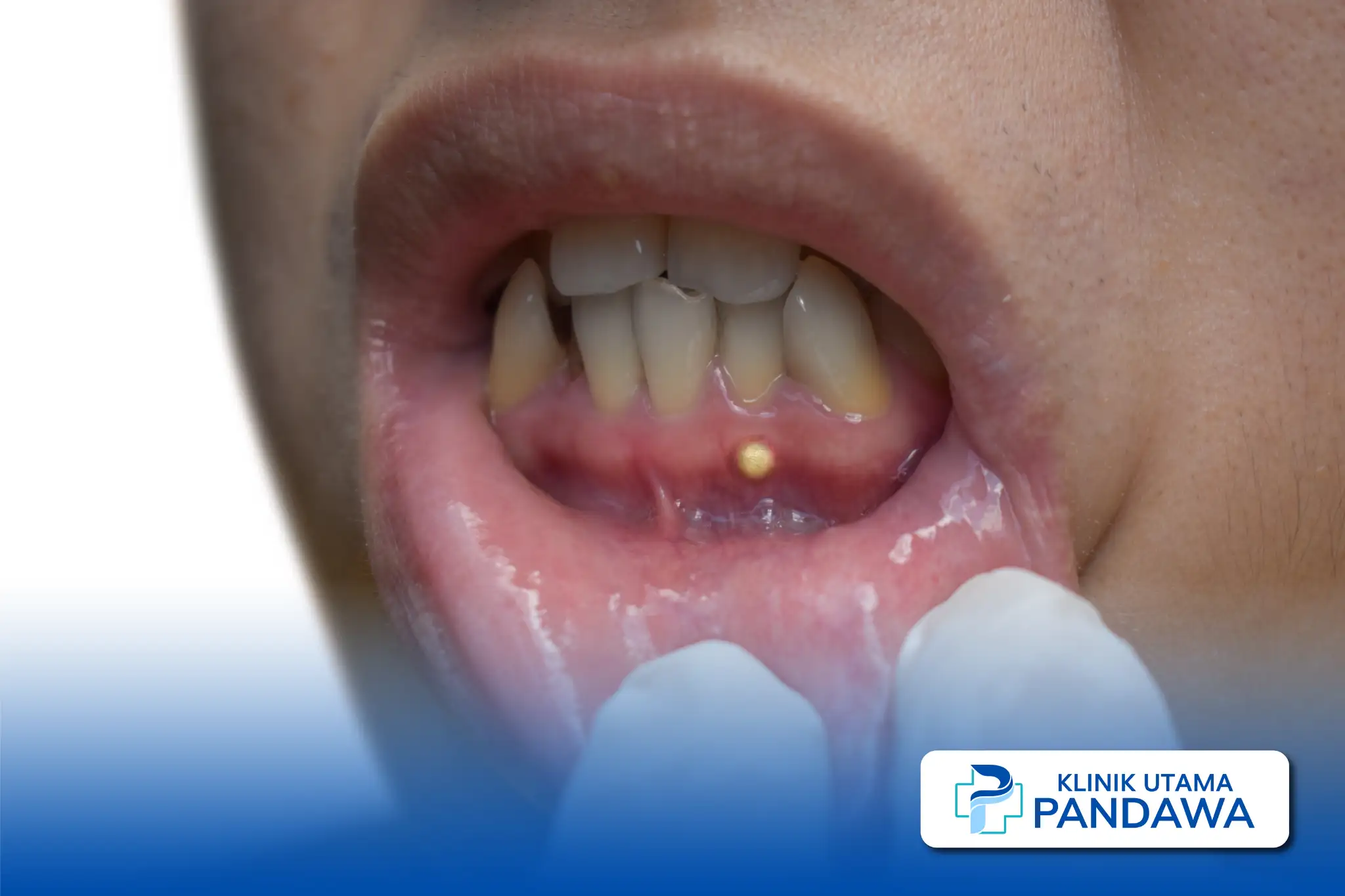 Abses periodontal